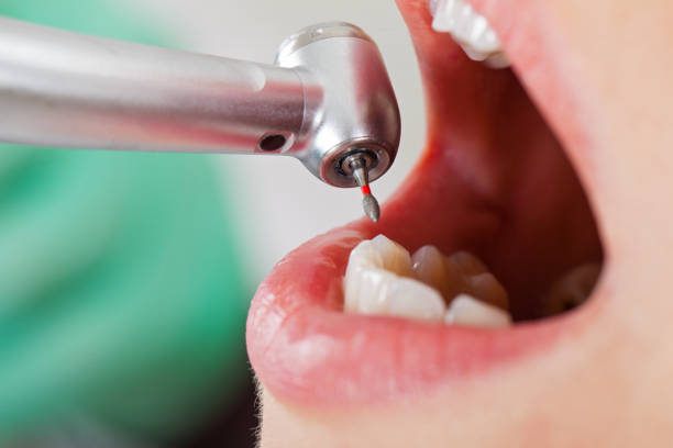 Best Emergency Dentist for Knocked-Out Tooth in Acres Green, CO